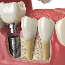 Osseointegration is the third step in the four-step dental implant process